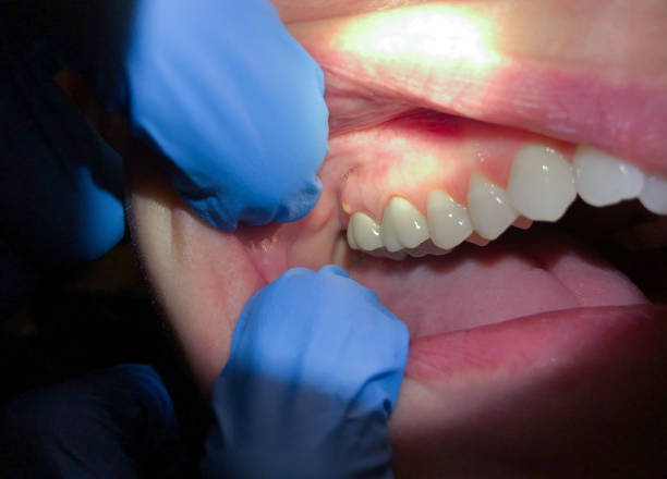 Best Emergency Treatment for Dental Infections or Abscesses in Collinsville, VA